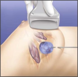 Ablative Therapy for Breast