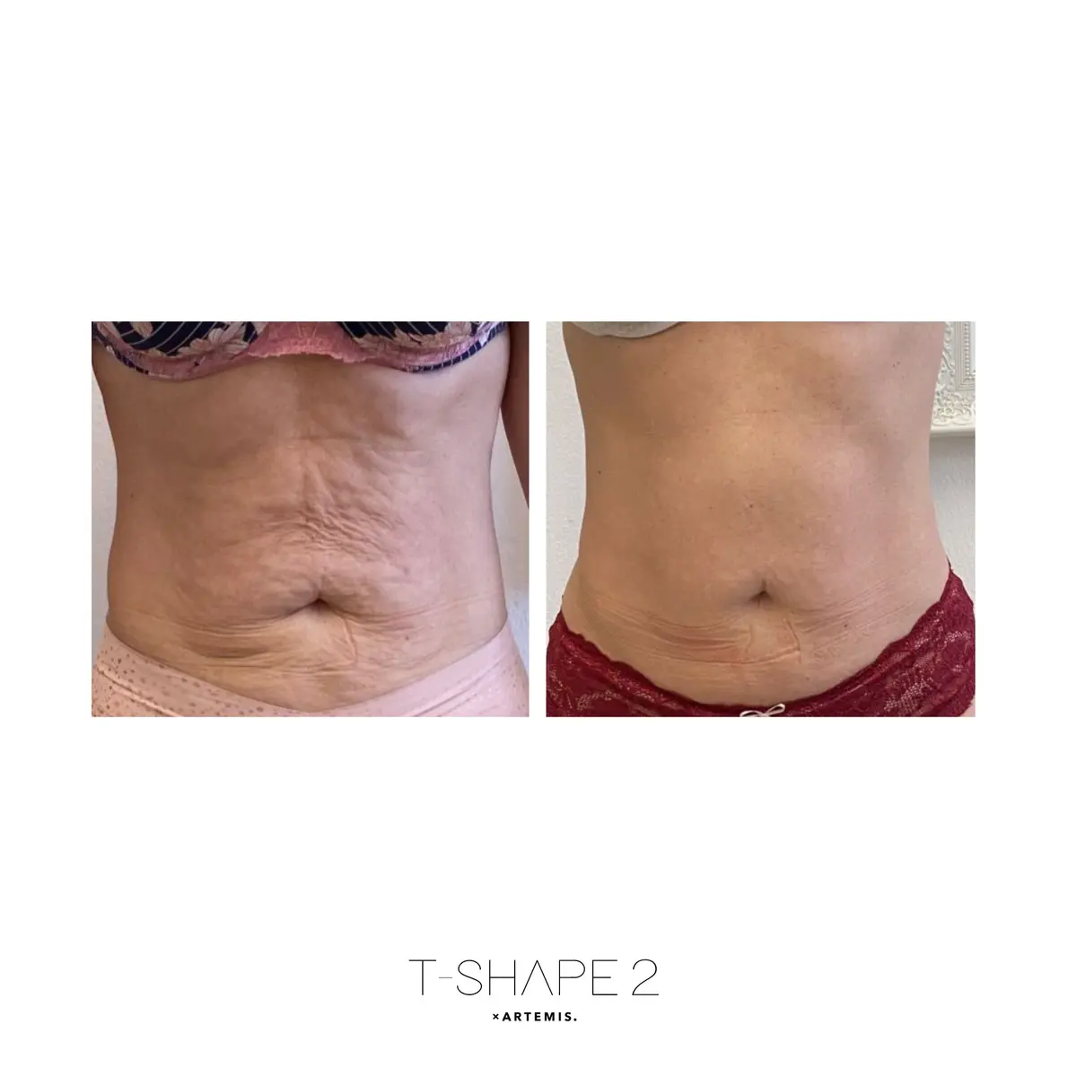 Abdomen before and after treatment