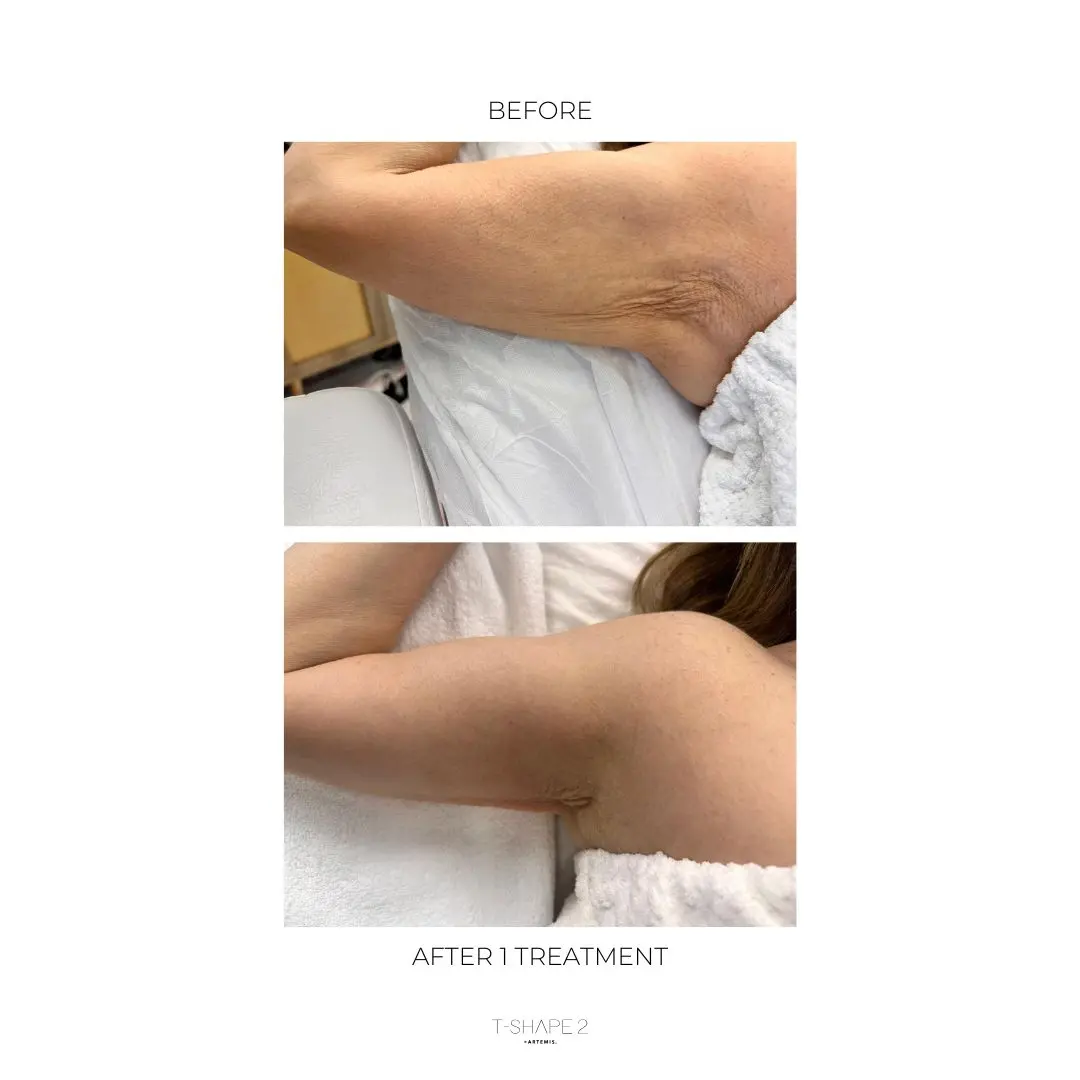 Upper arm before and after one treatment