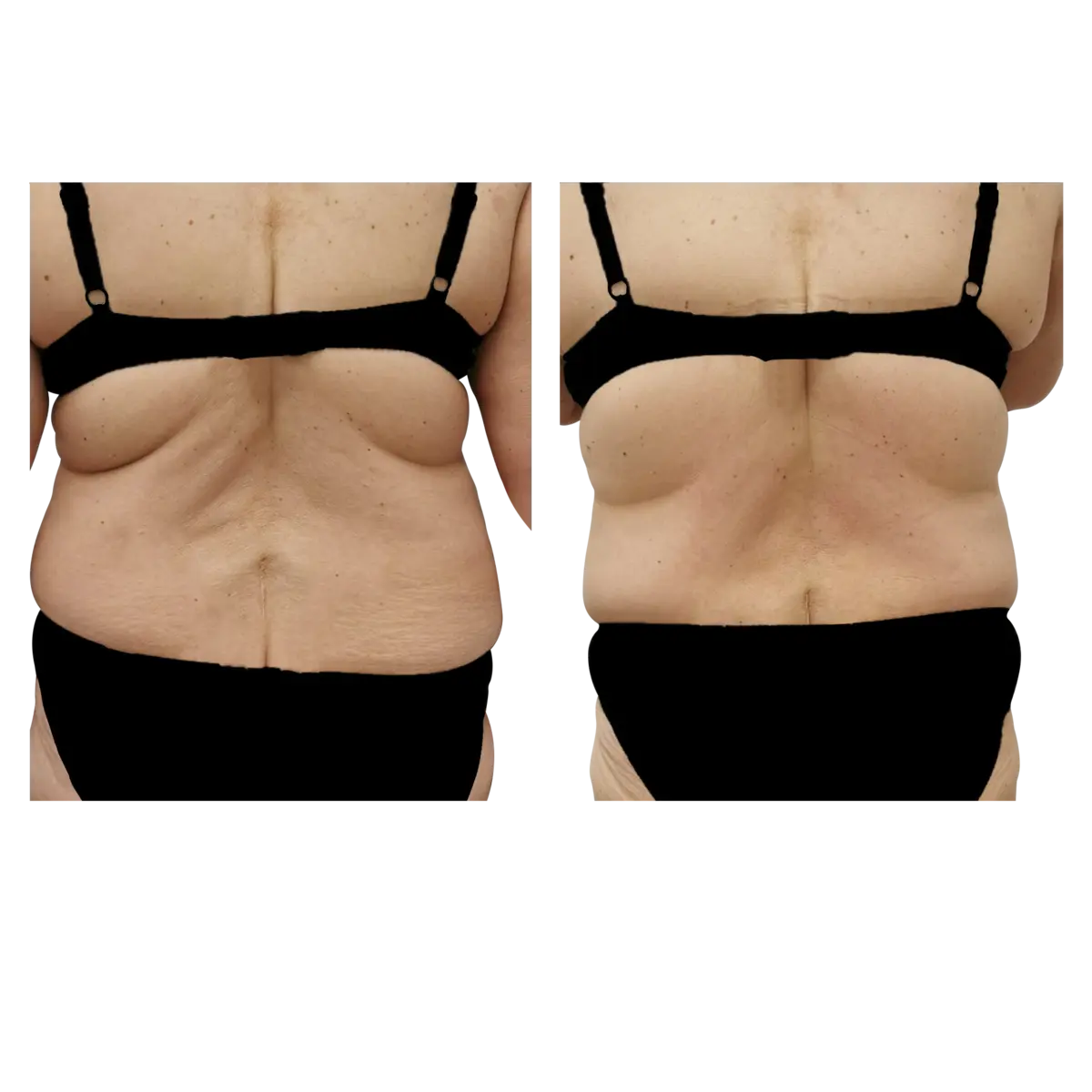 Back before and after ten treatments