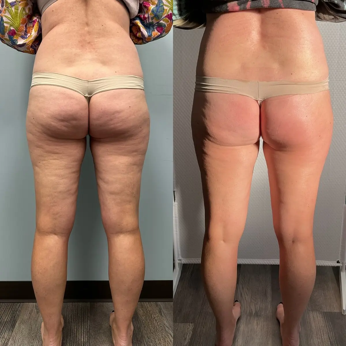 Back and legs before and after three treatments