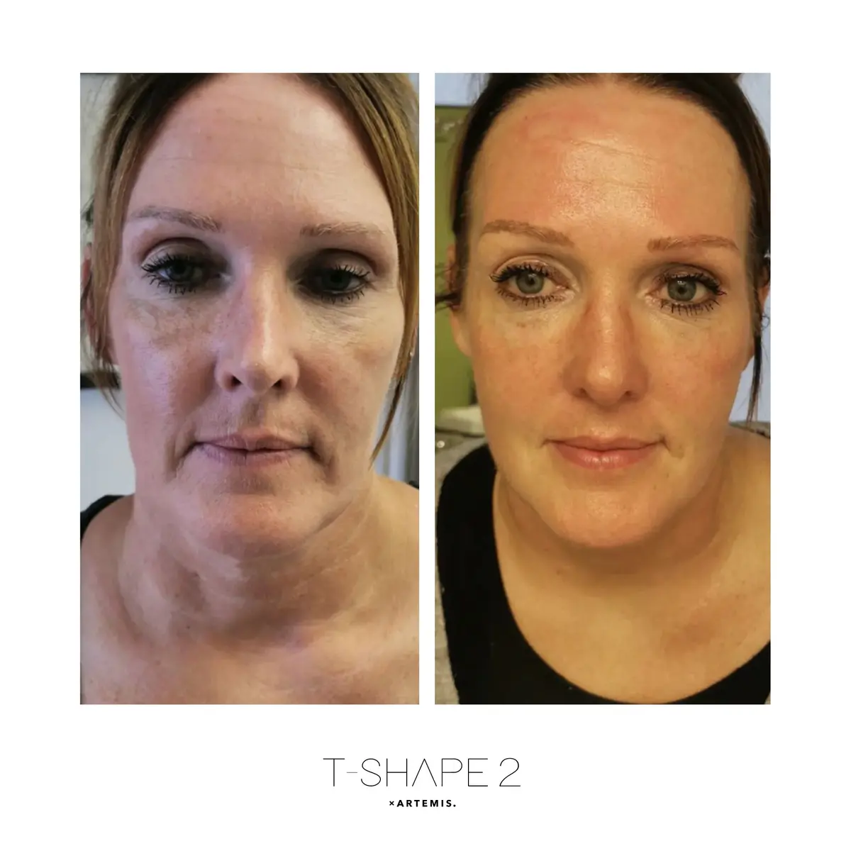 Face before and after four treatments