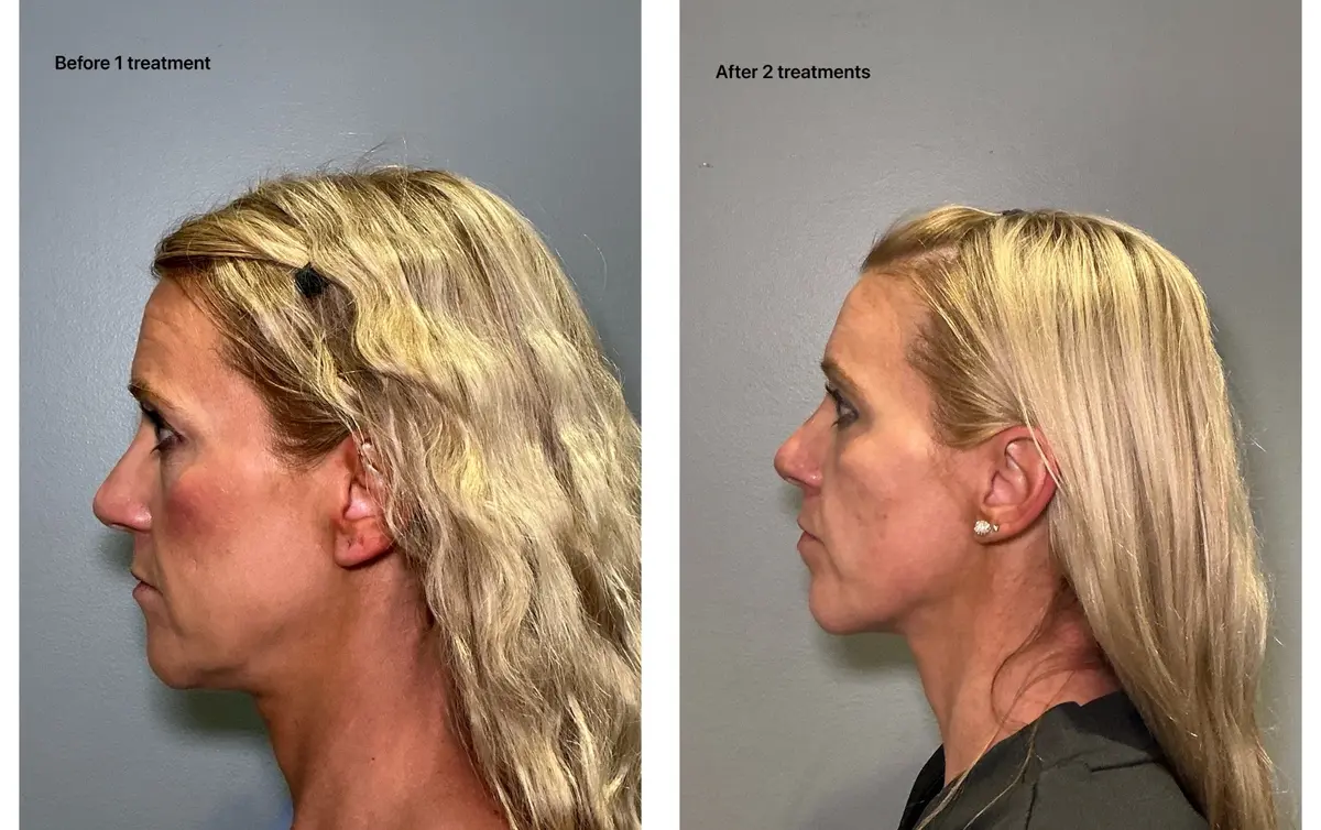 Face and jawline before and after two treatments