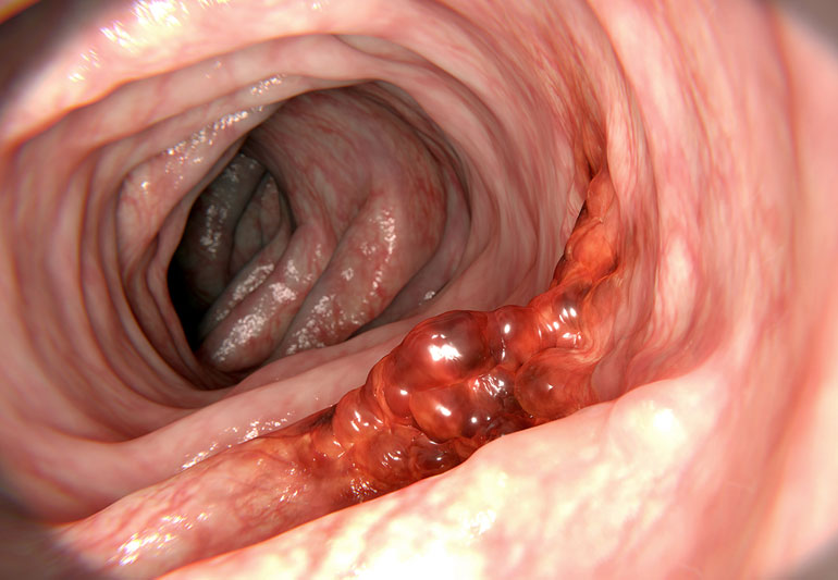 Colon Cancer