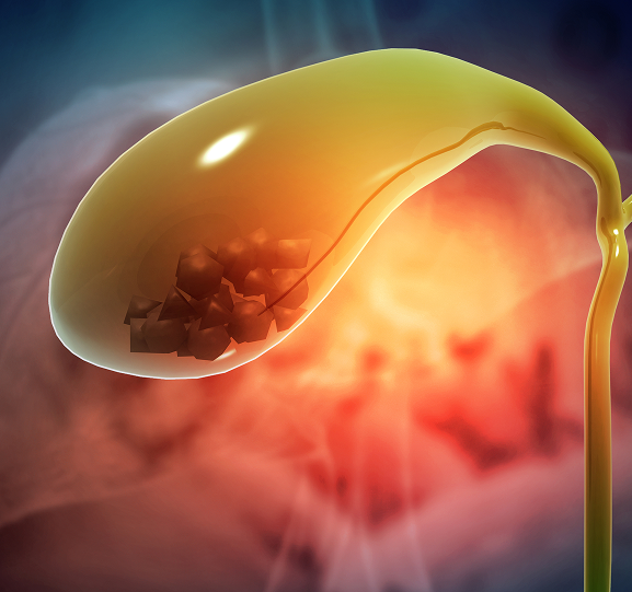 Gallbladder Surgery