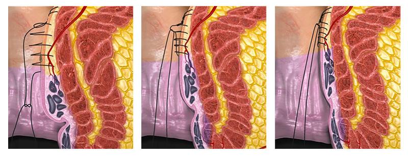 Cryoablation Treatment Banner